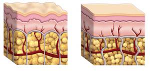cellulite cross section